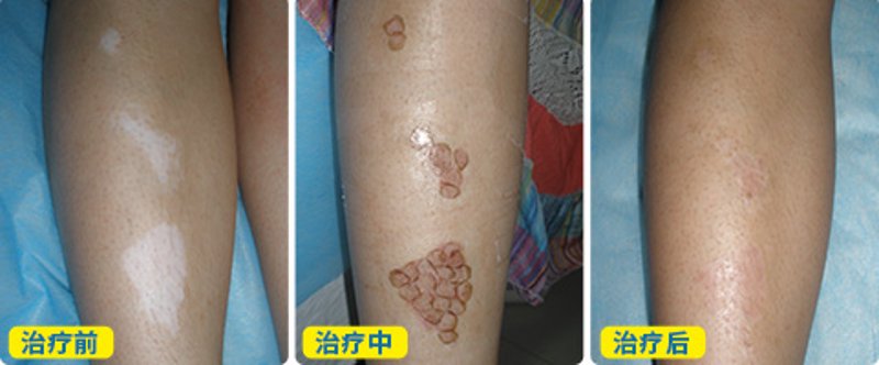 天水地区白癜风防治动态：寻找优质治疗方案